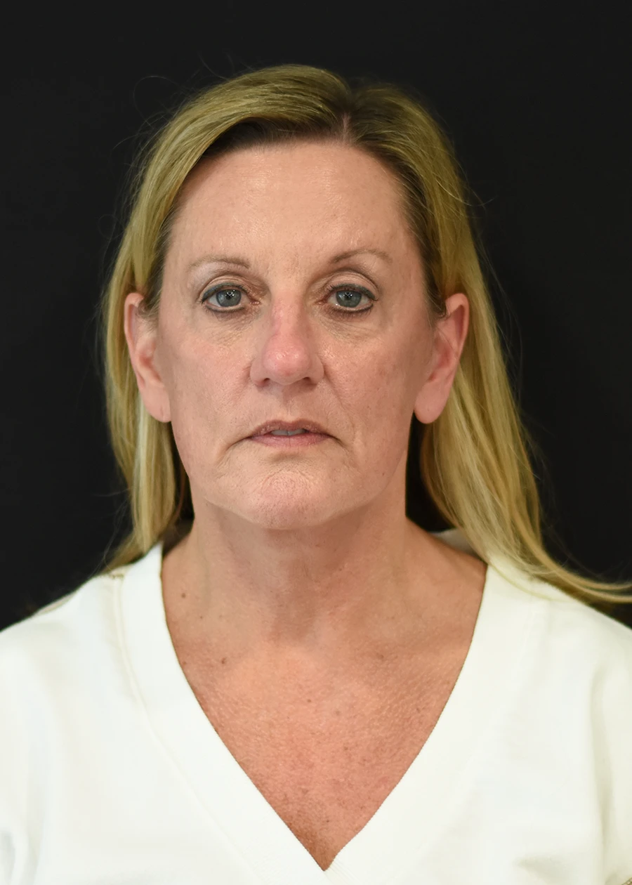 Extended Deep Plane Facelift Patient 9 Set 1 After