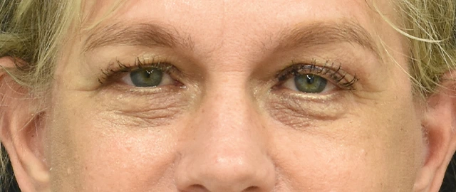Eyelid Surgery Patient 26 Set 1 After